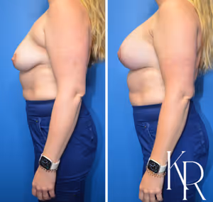 Breast lift with implants before and after photo, side view