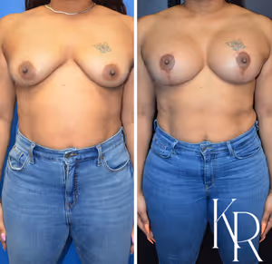 Breast lift with implants before and after photo, front view