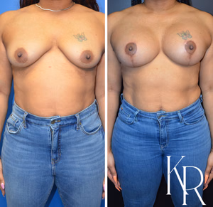 Breast lift with implants before and after photo, front view