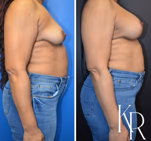 Breast lift with implants before and after photo, side view