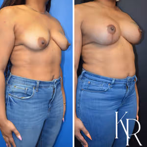 Breast lift with implants before and after photo, front view