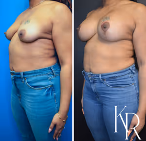 Breast lift with implants before and after photo, front view