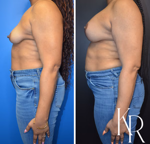 Breast lift with implants before and after photo, side view