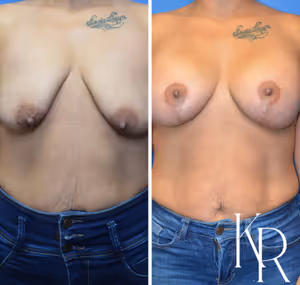 Breast lift with implants before and after photo, front view