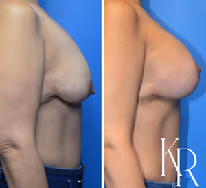 Breast lift with implants before and after photo, side view