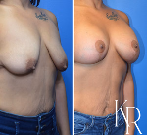 Breast lift with implants before and after photo, oblique view