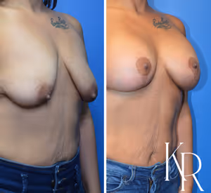Breast lift with implants before and after photo, oblique view