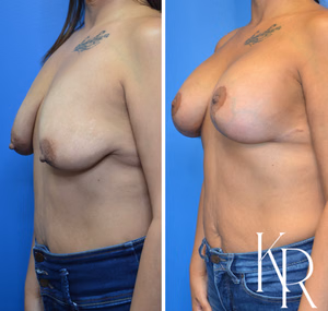 Breast lift with implants before and after photo, oblique view
