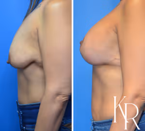 Breast lift with implants before and after photo, side view
