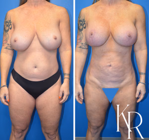 Breast lift with implants before and after photo, front view