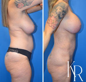 Breast lift with implants before and after photo, side view