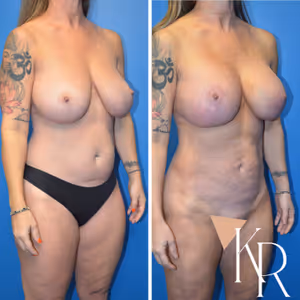 Breast lift with implants before and after photo, front view