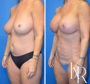 Breast lift with implants before and after photo, oblique view