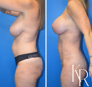 Breast lift with implants before and after photo, side view