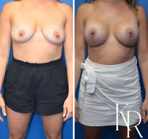 Breast lift with implants before and after photo, front view