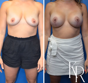Breast lift with implants before and after photo, front view