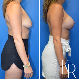 Breast lift with implants before and after photo, side view