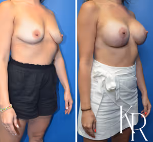 Breast lift with implants before and after photo, front view