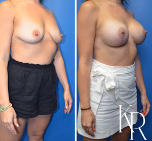 Breast lift with implants before and after photo, front view