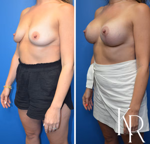 Breast lift with implants before and after photo, front view