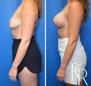 Breast lift with implants before and after photo, side view