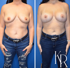 Breast lift with implants before and after photo, front view