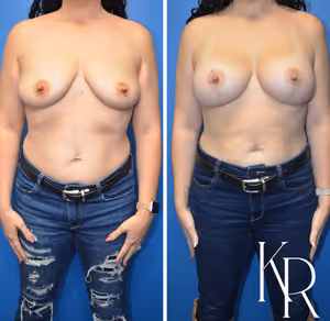 Breast lift with implants before and after photo, front view