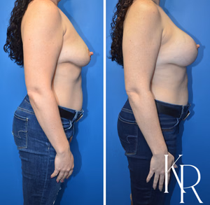 Breast lift with implants before and after photo, side view
