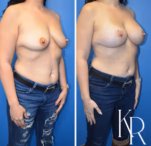 Breast lift with implants before and after photo, front view