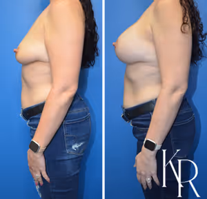 Breast lift with implants before and after photo, side view