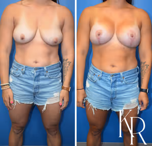 Breast lift with implants before and after photo, front view