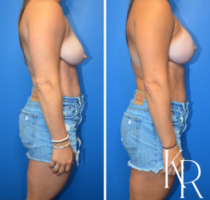 Breast lift with implants before and after photo, side view