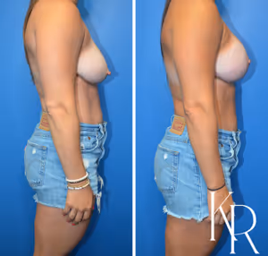 Breast lift with implants before and after photo, side view