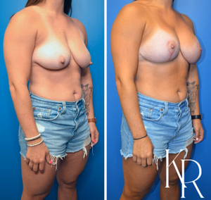 Breast lift with implants before and after photo, front view