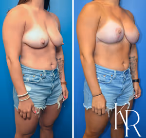 Breast lift with implants before and after photo, front view