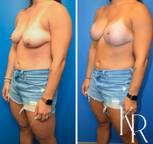 Breast lift with implants before and after photo, front view