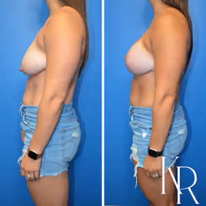 Breast lift with implants before and after photo, side view