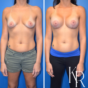 Breast lift with implants before and after photo, front view
