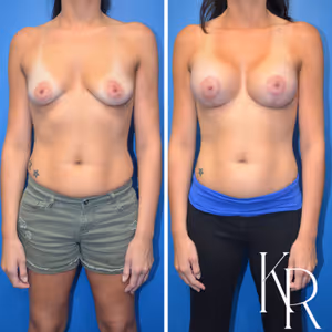 Breast lift with implants before and after photo, front view