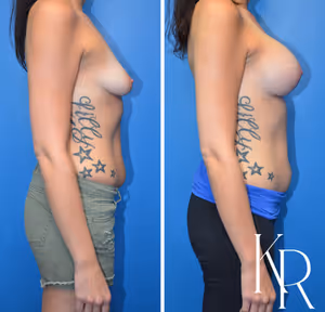 Breast lift with implants before and after photo, side view