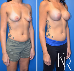 Breast lift with implants before and after photo, front view
