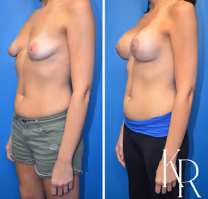 Breast lift with implants before and after photo, oblique view