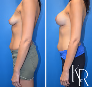 Breast lift with implants before and after photo, side view