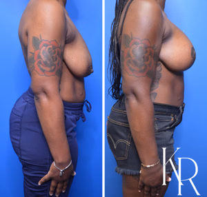 Breast lift with implants before and after photo, side view