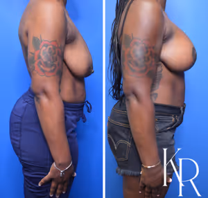 Breast lift with implants before and after photo, side view