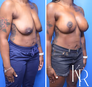 Breast lift with implants before and after photo, front view