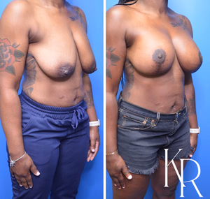 Breast lift with implants before and after photo, front view