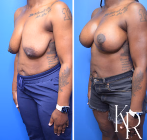 Breast lift with implants before and after photo, front view