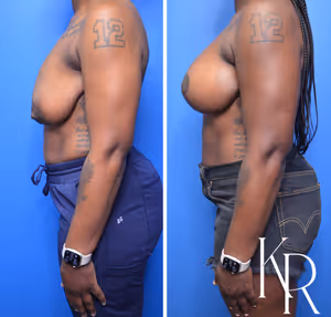 Breast lift with implants before and after photo, side view