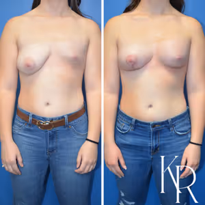 Breast lift with implants before and after photo, front view